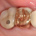 dental-crowns-before-brian-novak